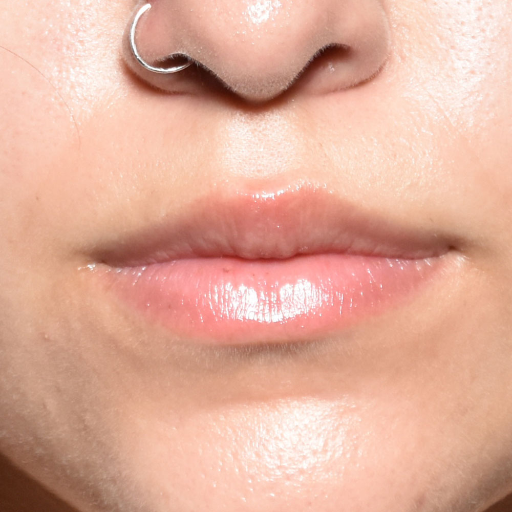 Case--2149 | Before Face Treatments