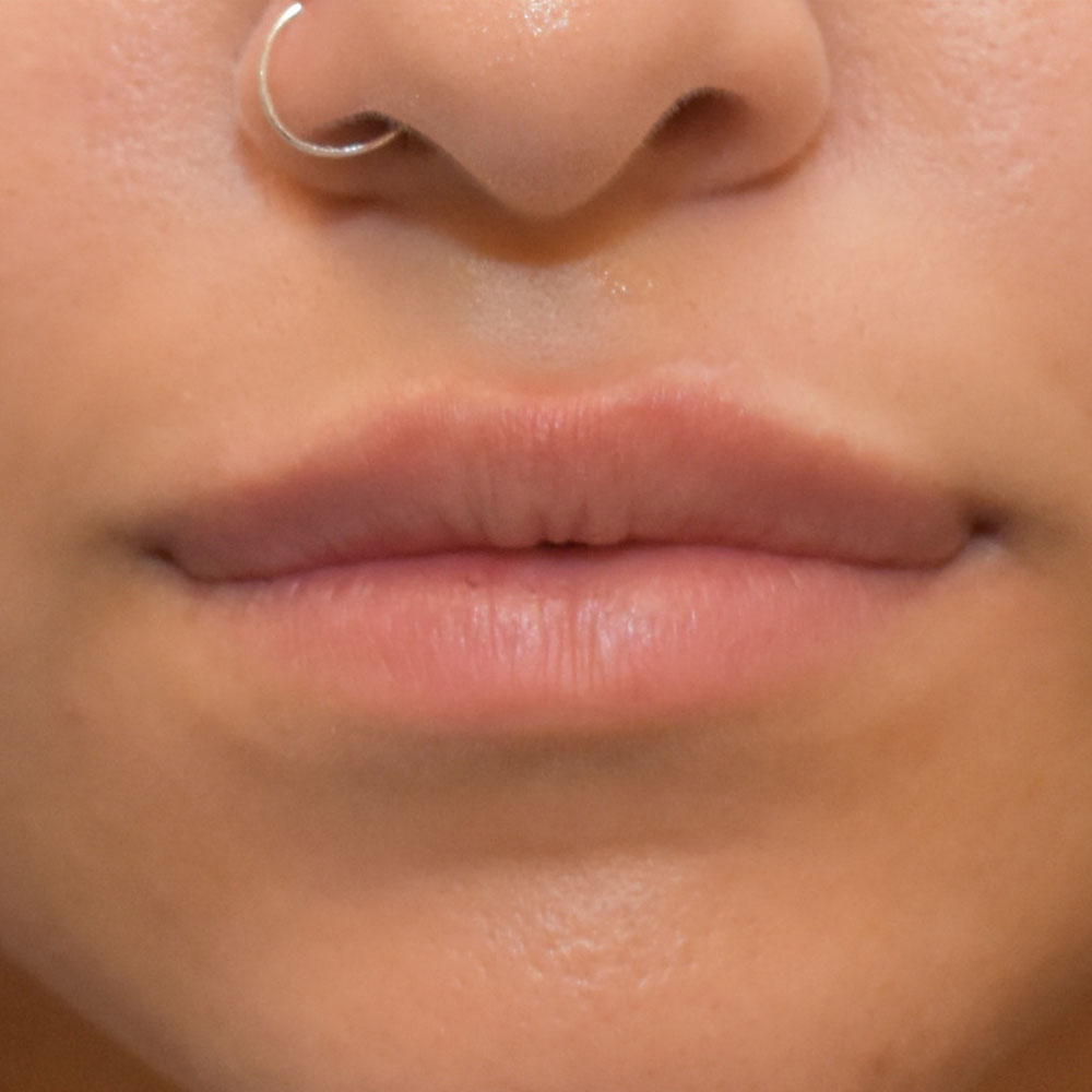 Case--2149 | After Face Treatments
