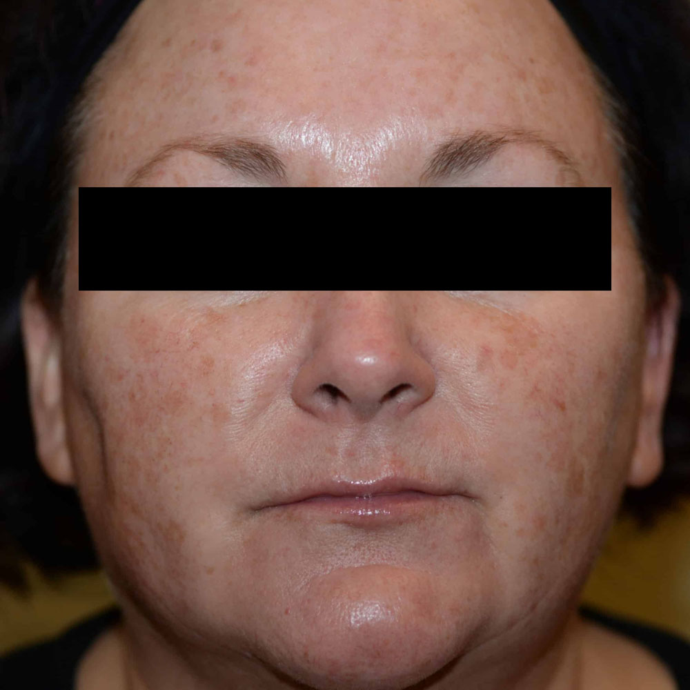 Case--2129 | Before Face Treatments