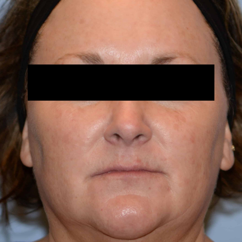 Case--2129 | After Face Treatments