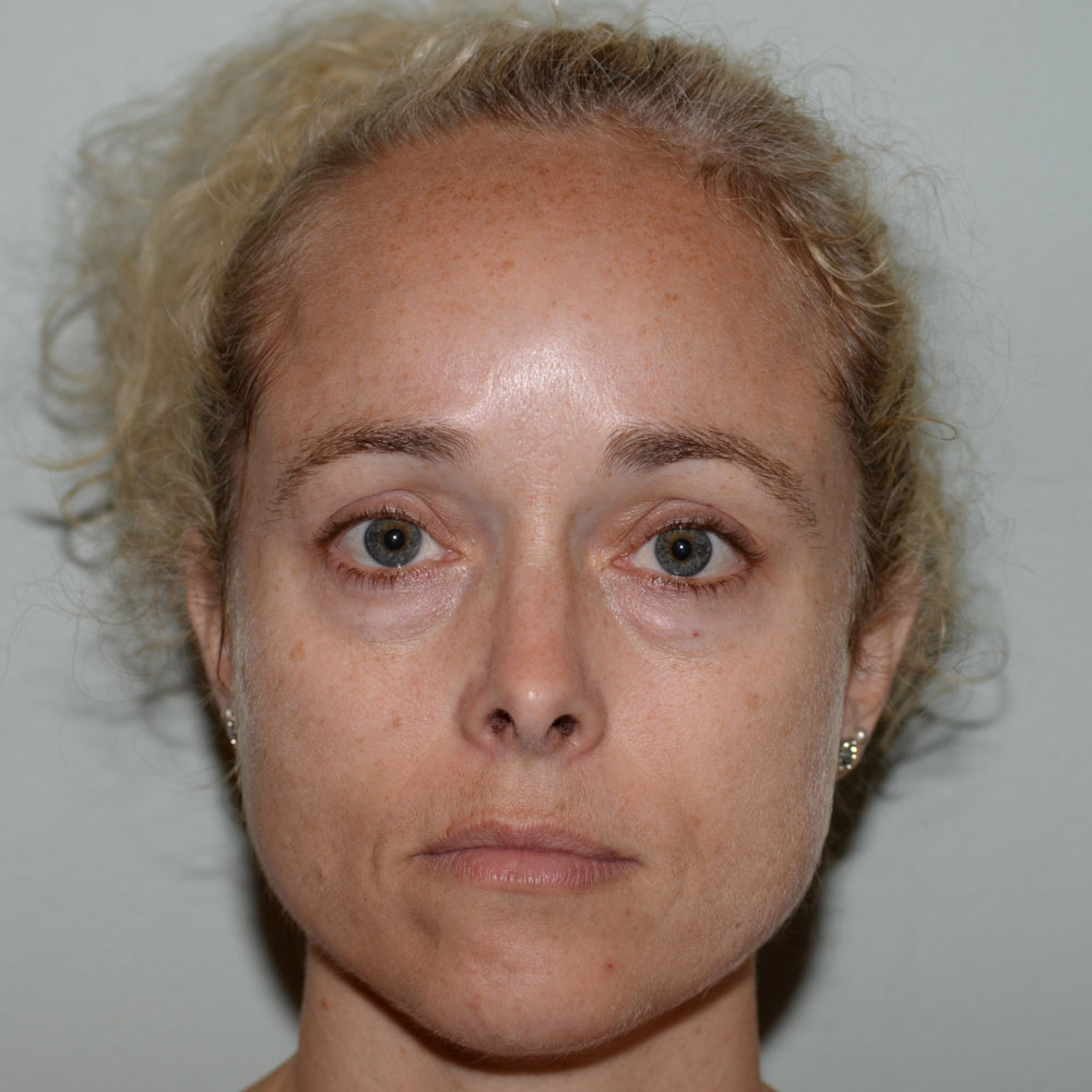 Case--2131 | Before Face Treatments
