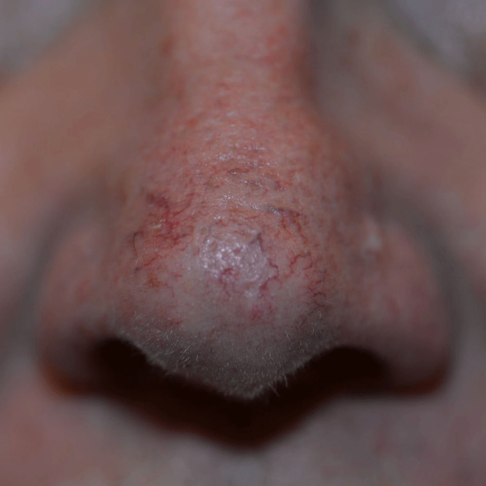 Case--2132 | Before Face Treatments