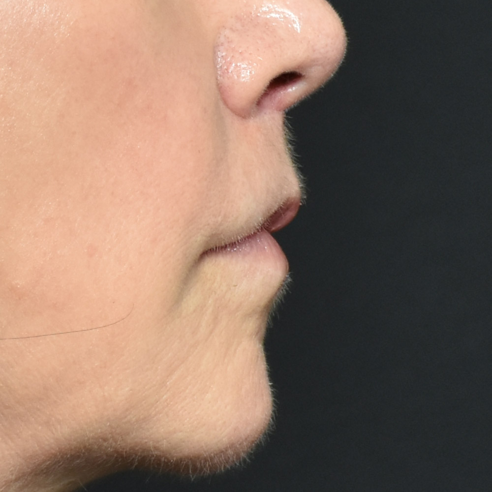 10947 After Lip Lift - Lake Oswego and Portland, Oregon