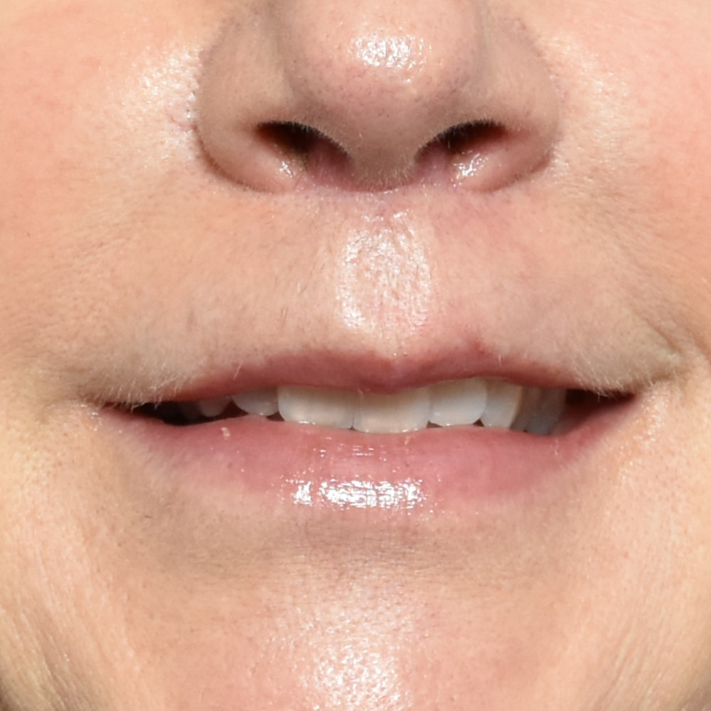 10947 After Lip Lift - Lake Oswego and Portland, Oregon