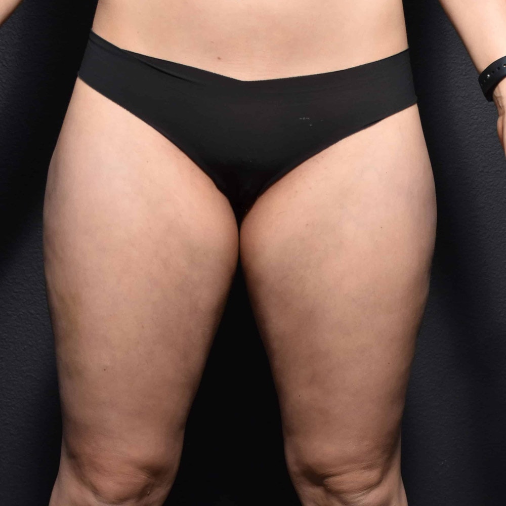 59734 After Liposuction Front View - Lake Oswego & Portland, OR