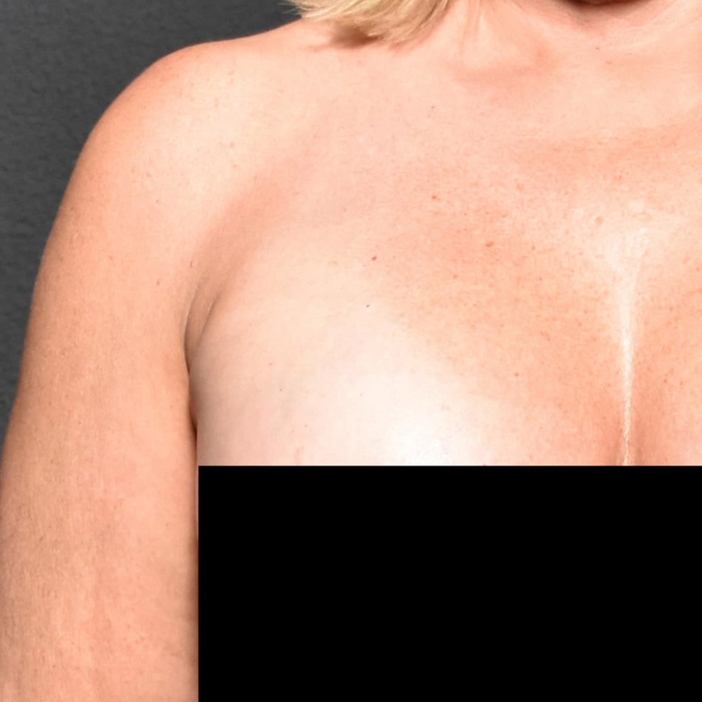 60205 After Liposuction Front View - Lake Oswego & Portland, OR