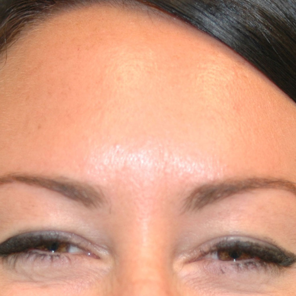 Neurotoxins 2915, Frowning, After Treatment - Lake Oswego and Portland, Oregon
