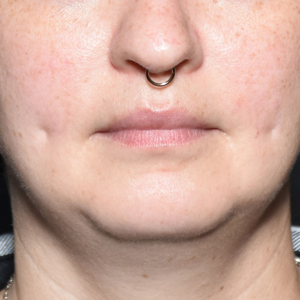 Case--2138 | Before Face Treatments