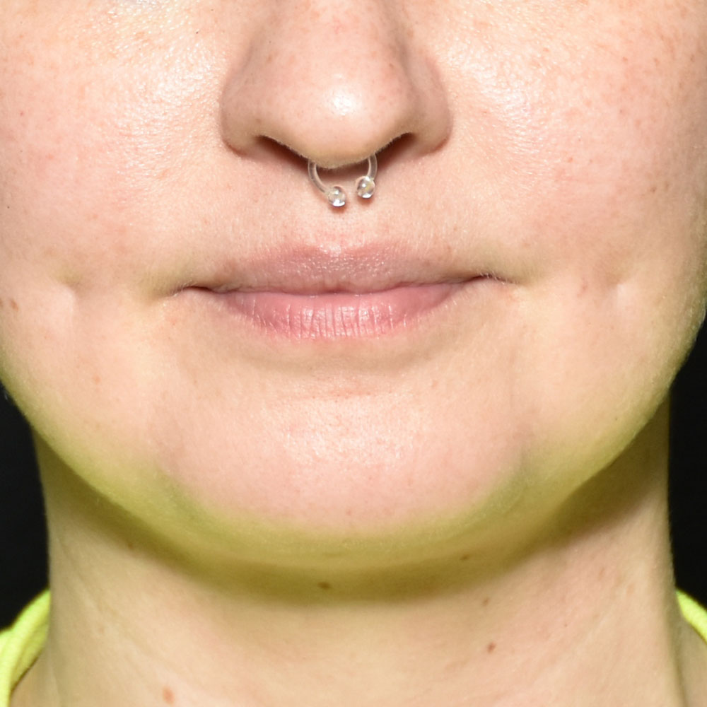 Case--2138 | After Face Treatments