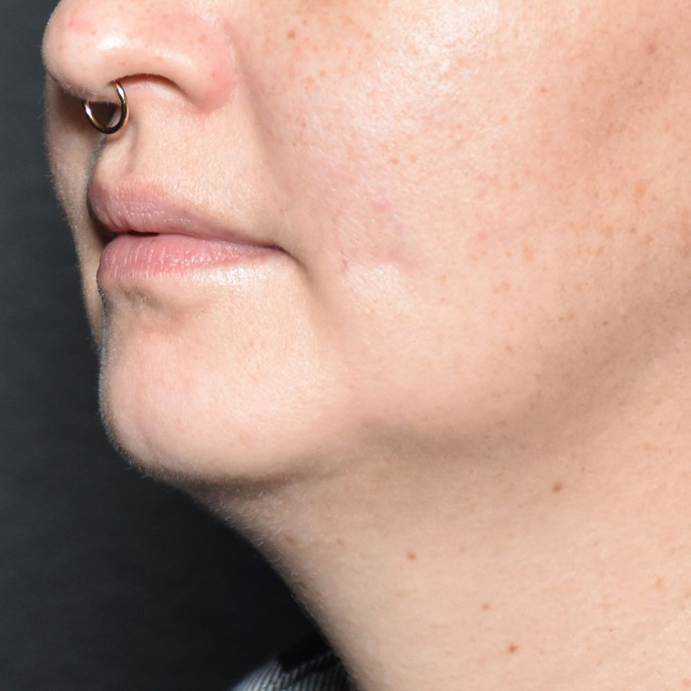 Case--2138 | Before Skin Tightening 2