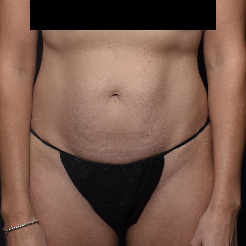 Case 10189 Front View, Before Tummy Tuck in Lake Oswego & Portland, OR