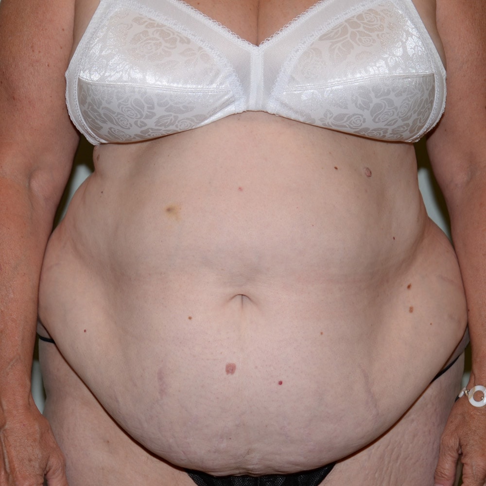 Case 5798 Front View, Before Tummy Tuck in Lake Oswego & Portland, OR