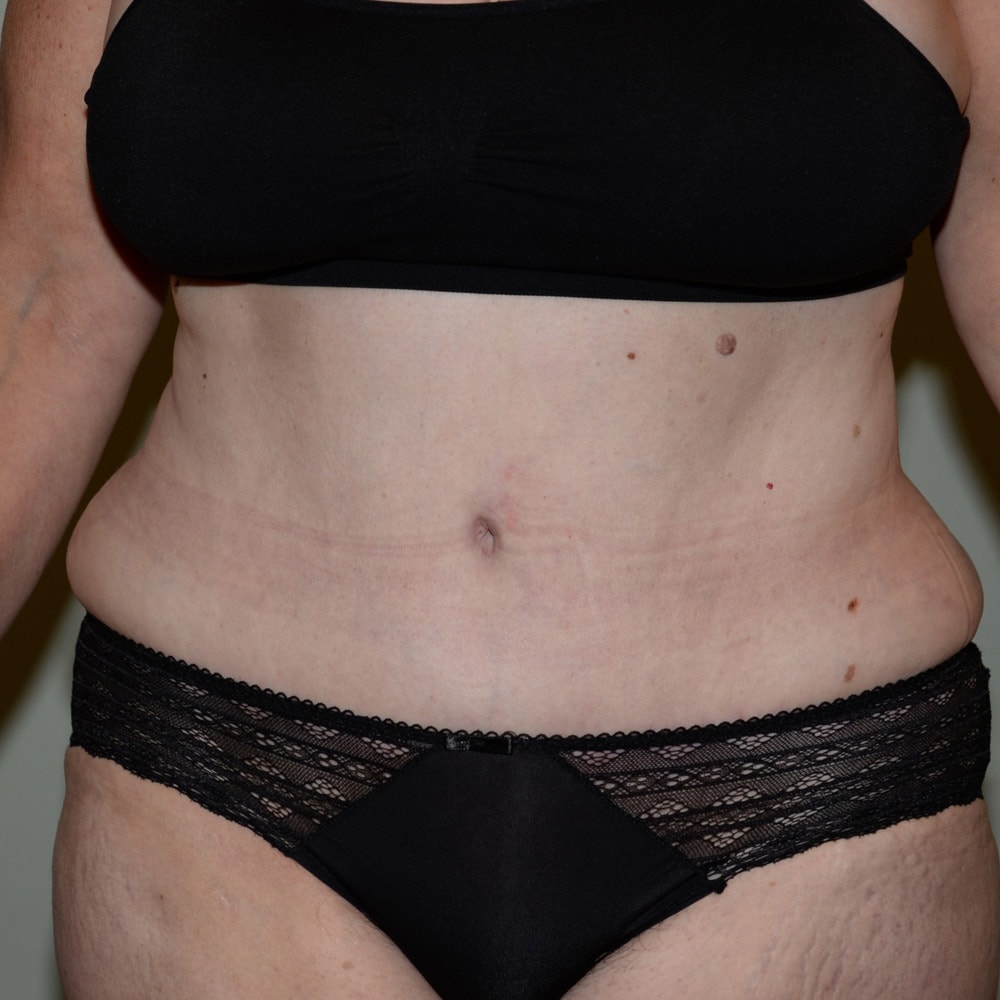 Case--5798 | After Tummy Tuck