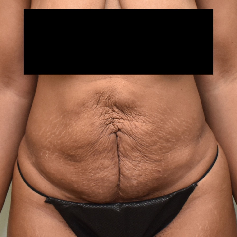 Case 7845 Front View, Before Tummy Tuck in Lake Oswego & Portland, OR