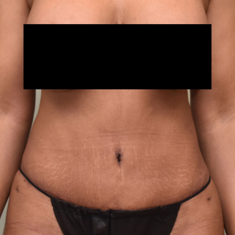 Case--1001 | After Tummy Tuck