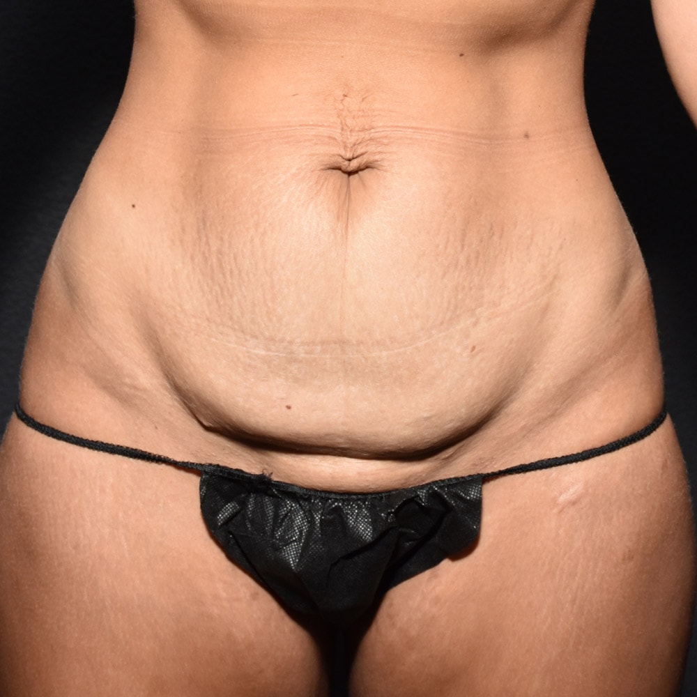 Case 9401 Front View, Before Tummy Tuck in Lake Oswego & Portland, OR