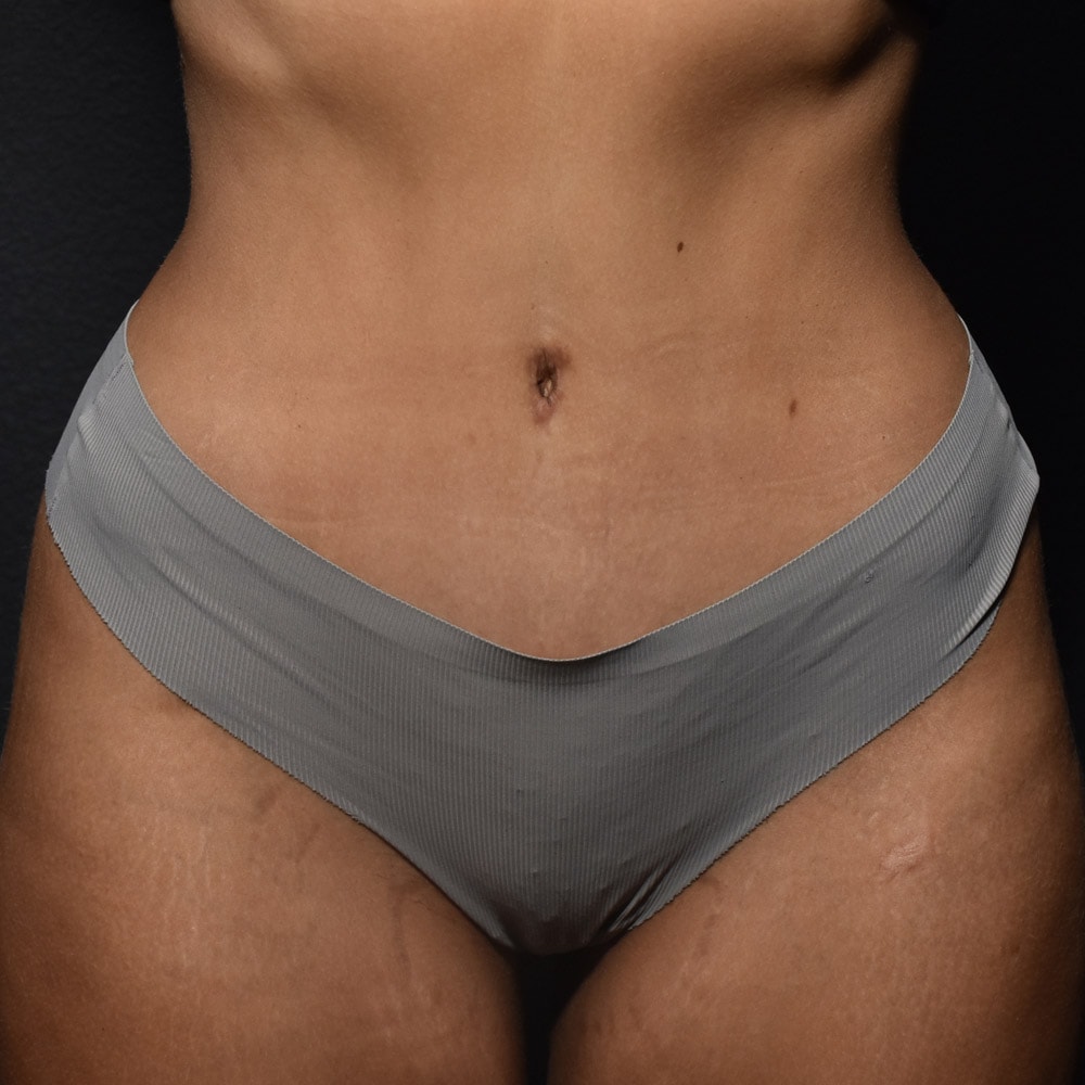 Case 9401 Front View, After Tummy Tuck in Lake Oswego & Portland, OR