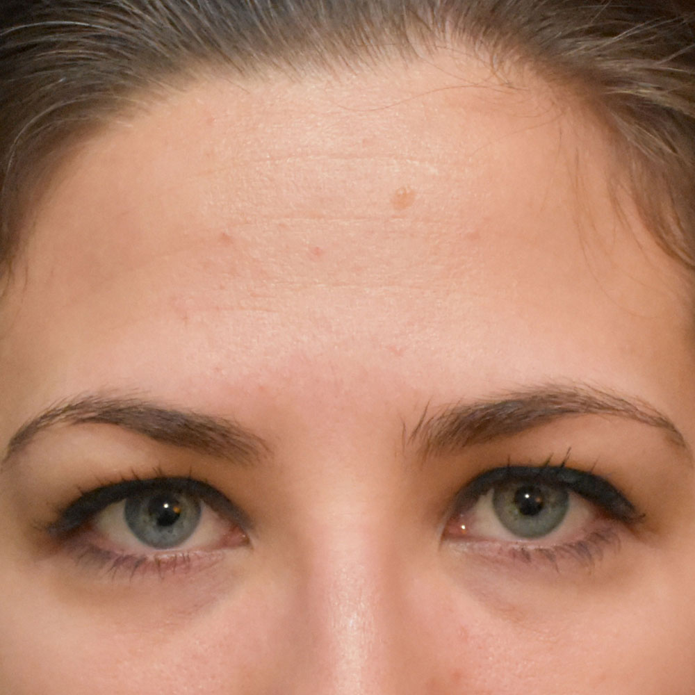 Case--2136 | After Ultherapy